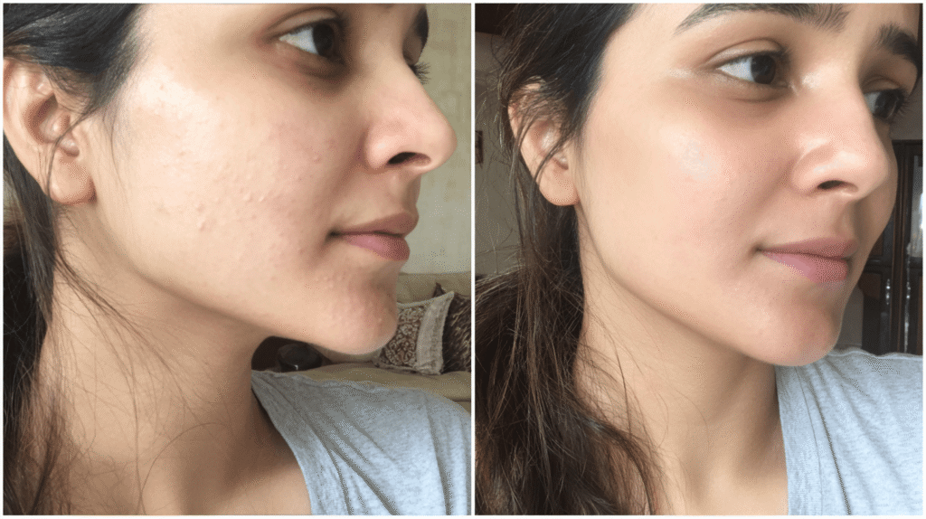 Before and after even skin tone improvement