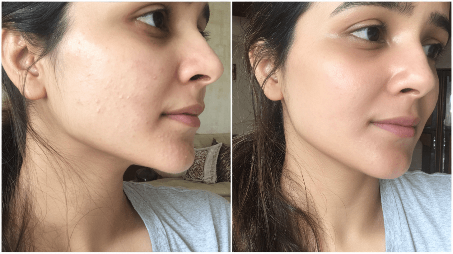 Before and after even skin tone improvement